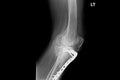 Internal of left leg fixed with plate and screws