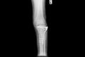 Internal of left leg fixed with plate and screws