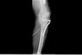 Internal of left leg fixed with plate and screws Royalty Free Stock Photo