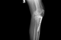 Internal of left leg fixed with plate and screws Royalty Free Stock Photo