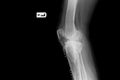 Internal of left leg fixed with plate and screws