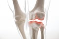 Medically accurate representation of an arthritic knee joint, knee meniscus, human leg, 3d illustration Royalty Free Stock Photo