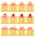 Internal structure of tooth Royalty Free Stock Photo