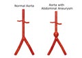 Internal view of the human body demonstrating a normal aorta and aortic aneurysm in the thoracic and abdominal region