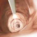 Internal view of the intestinal walls. Colonoscopy is the endoscopic examination of the large bowel and the small bowel