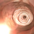 Internal view of the intestinal walls. Colonoscopy is the endoscopic examination of the large bowel and the small bowel