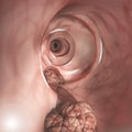 Internal view of the intestinal walls. Colorectal cancer CRC, bowel cancer, colon cancer, or rectal cancer