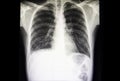 interstital lung disease with minimal pleural effusion