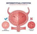 Interstitial cystitis as urinary bladder wall inflammation outline diagram Royalty Free Stock Photo