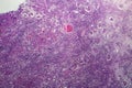 Interstitial nephritis, light micrograph Royalty Free Stock Photo