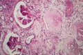 Interstitial nephritis, light micrograph Royalty Free Stock Photo