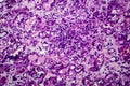 Interstitial nephritis, light micrograph Royalty Free Stock Photo