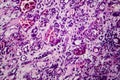 Interstitial nephritis, light micrograph Royalty Free Stock Photo