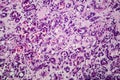 Interstitial nephritis, light micrograph Royalty Free Stock Photo