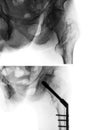 Intertrochanteric fracture femur thigh bone . X-ray of hip and comparison between before surgery upper image and after surger Royalty Free Stock Photo