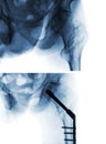 Intertrochanteric fracture femur thigh bone . X-ray of hip and comparison between before surgery upper image and after surger Royalty Free Stock Photo