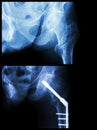 Intertrochanteric fracture left femur (fracture thigh's bone). It was operated and insert intramedullary nail.