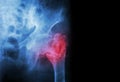 Intertrochanteric ( Neck of femur ) fracture left femur ( Thigh bone ) and blank area at right side Royalty Free Stock Photo