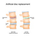 Intervertebral disc arthroplasty