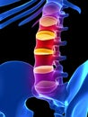 Intervertebral disks