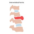 intervertebral hernia concept