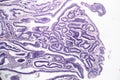 Intestinal adenomas, light micrograph