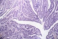 Intestinal adenomas, light micrograph