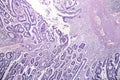 Intestinal adenomas, light micrograph