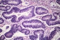 Intestinal adenomas, light micrograph