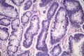 Intestinal adenomas, light micrograph