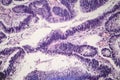 Intestinal adenomas, light micrograph