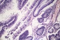 Intestinal adenomas, light micrograph