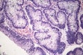 Intestinal adenomas, light micrograph