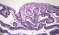 Intestinal adenomas, light micrograph