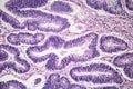 Intestinal adenomas, light micrograph