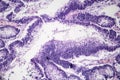 Intestinal adenomas, light micrograph