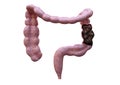 Intestinal constipation. Bowel disorder characterized by difficulty in excreting faeces. Laxatives resolve the disorder