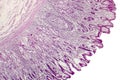 Intestinal metaplasia, light micrograph