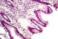 Intestinal metaplasia, light micrograph