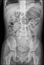 Intestinal obstruction in a child x ray, Film X-ray body of child