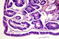 Intestinal polypoid adenoma