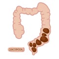 Intestine with constipation internal organs digestive system. Abdominal pain. Human large intestine with fecal matter