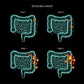 Intestine 3D cancer