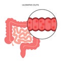 intestine ulcerative colitis Royalty Free Stock Photo