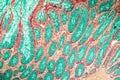 Intestine with villi and goblet cells Carcinoma tissue