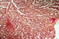 Intestine with villi and goblet cells Carcinoma tissue