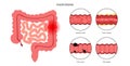 Intestines diseases concept