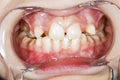 Intra-oral picture of teeth and gum in the smile mouth oral care. Bacteria, dental plaque is the cause of gingivitis and tooth