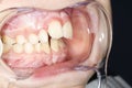 Intra-oral picture of teeth and gum in the smile mouth oral care. Bacteria, dental plaque is the cause of gingivitis and tooth