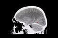 intracerebral hemorrhage